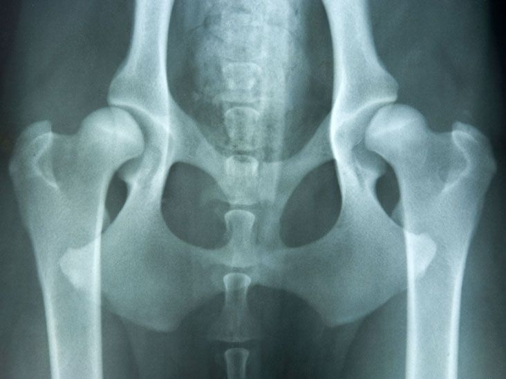 Congenital Hip Dislocation: Causes, Symptoms, and Diagnosis
