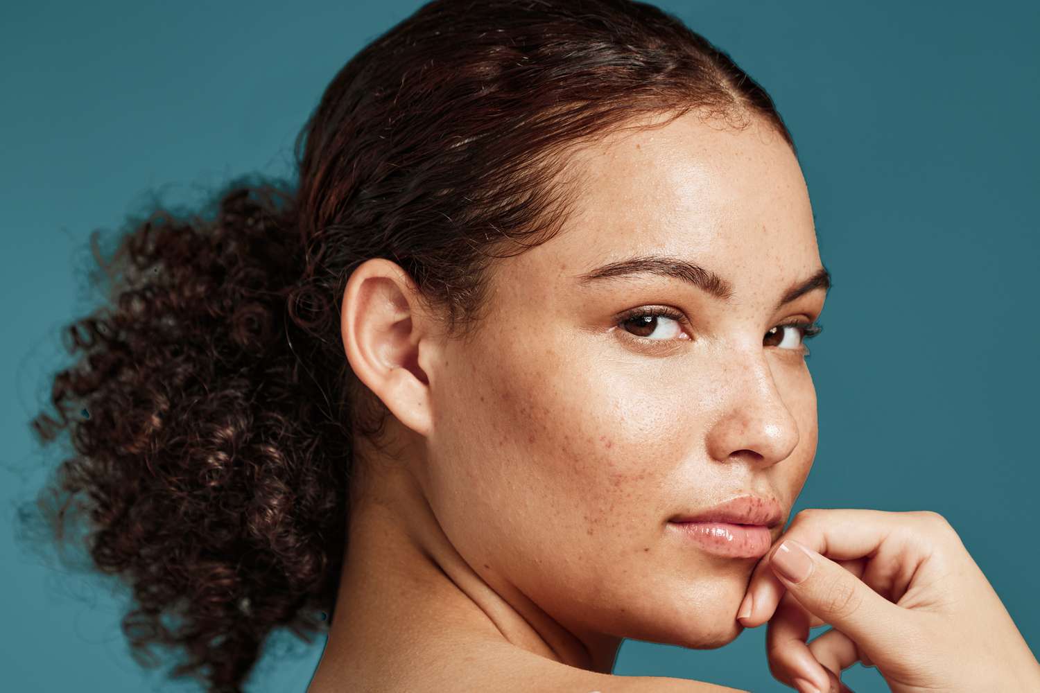 What Are Sebum Plugsand How Do You Get Rid of Them?