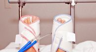 Arterial Embolism: Causes, Symptoms, and Diagnosis